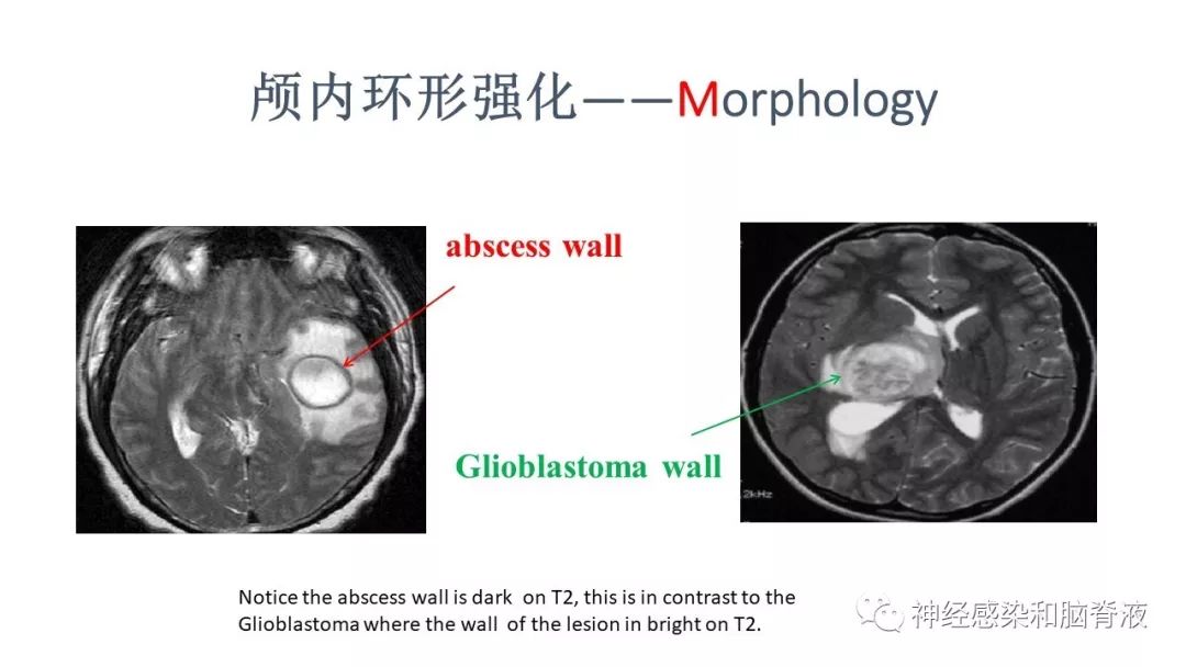 影像PPT - 【PPT】颅内环形强化：从原理到现象-30