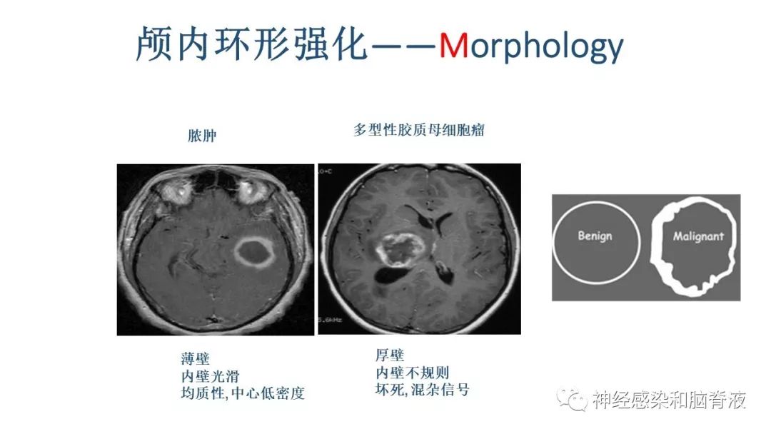 影像PPT - 【PPT】颅内环形强化：从原理到现象-31