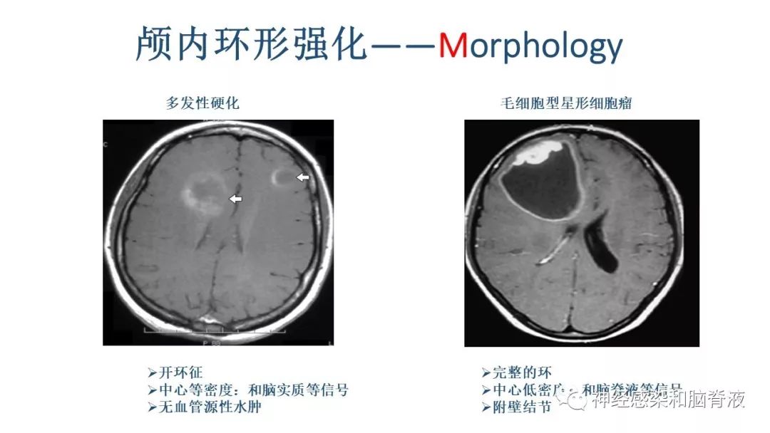 影像PPT - 【PPT】颅内环形强化：从原理到现象-32