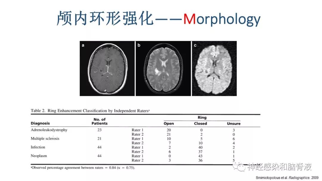 影像PPT - 【PPT】颅内环形强化：从原理到现象-33