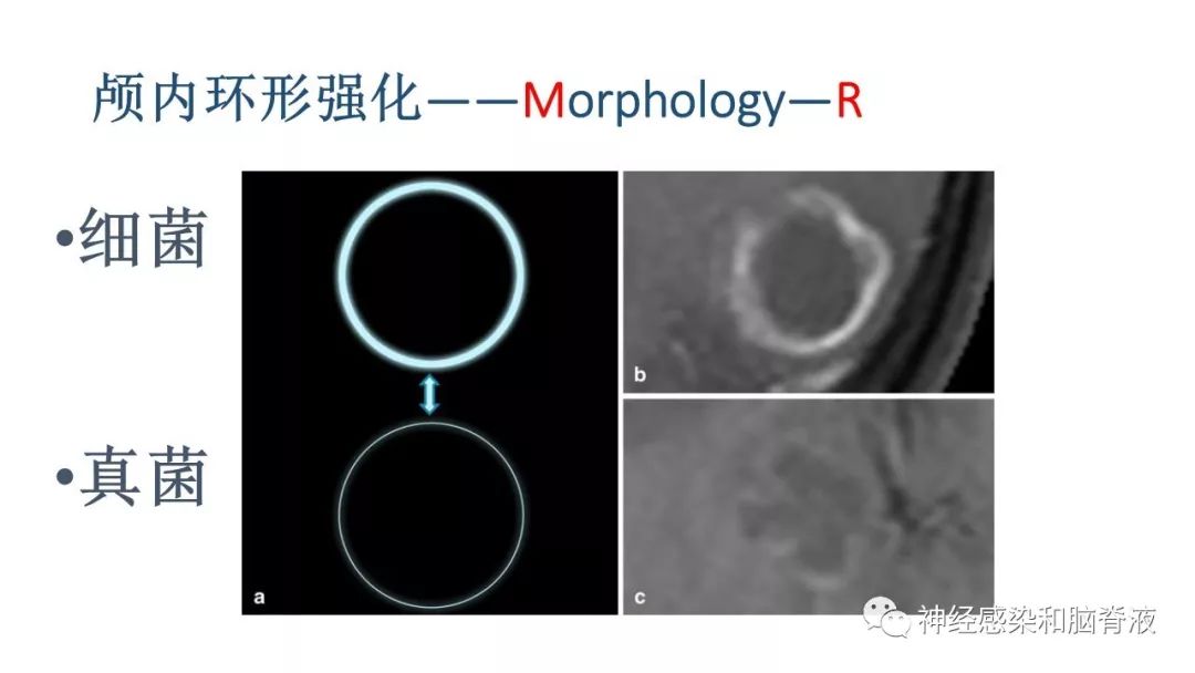 影像PPT - 【PPT】颅内环形强化：从原理到现象-34