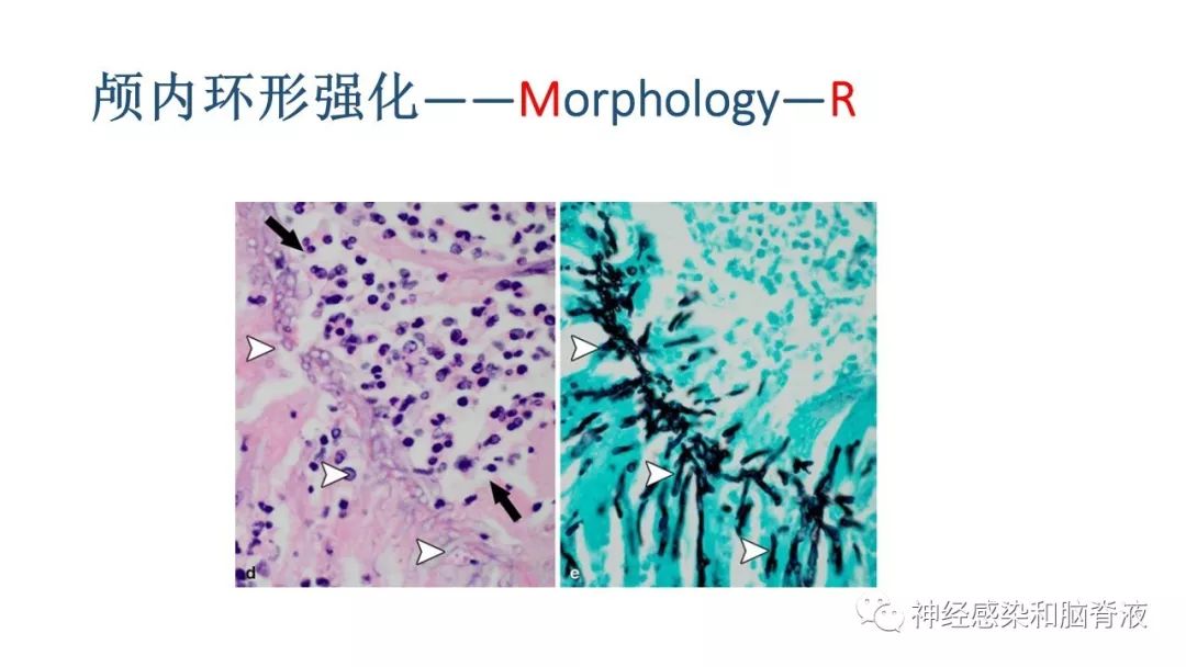 影像PPT - 【PPT】颅内环形强化：从原理到现象-35