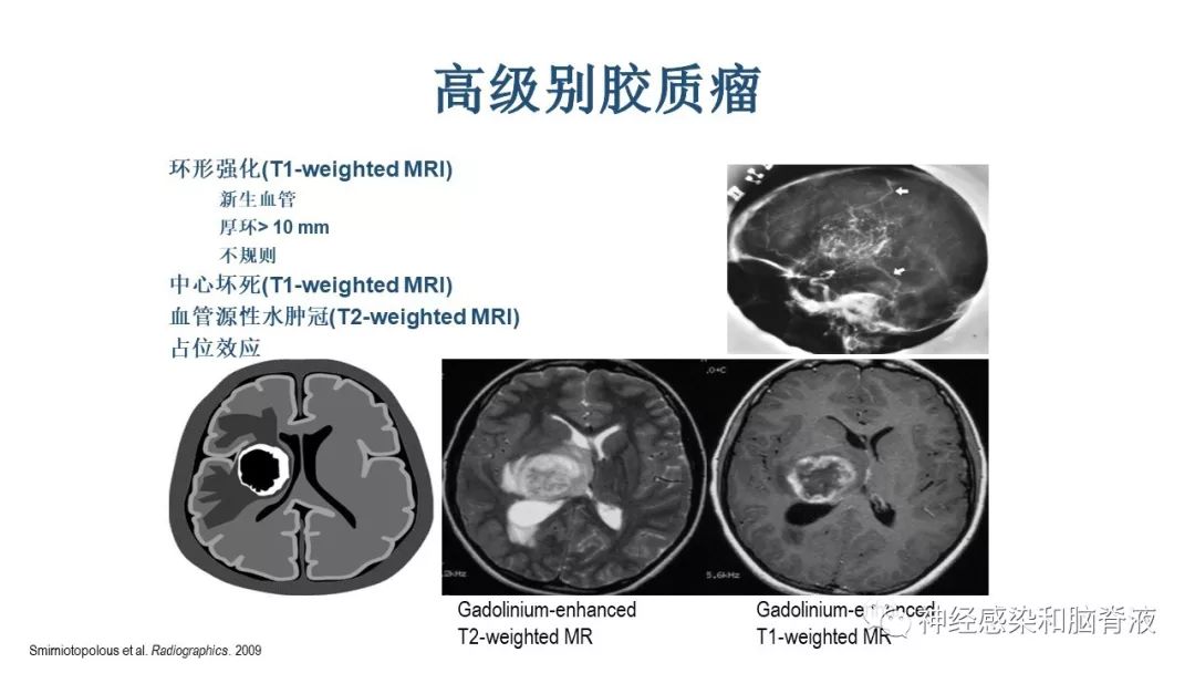 影像PPT - 【PPT】颅内环形强化：从原理到现象-37
