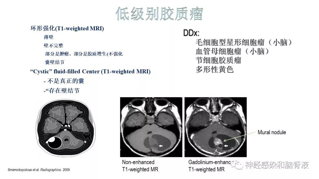 影像PPT - 【PPT】颅内环形强化：从原理到现象-38