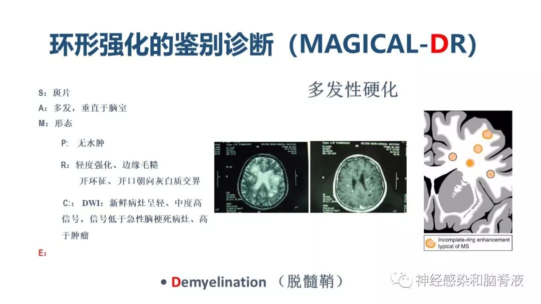 影像PPT - 【PPT】颅内环形强化：从原理到现象-43