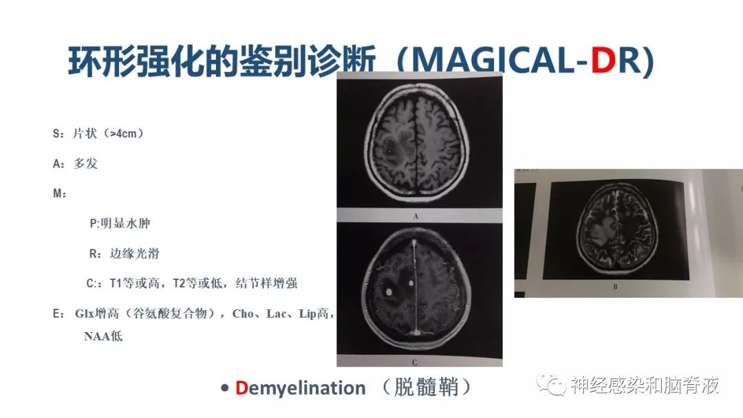 影像PPT - 【PPT】颅内环形强化：从原理到现象-45