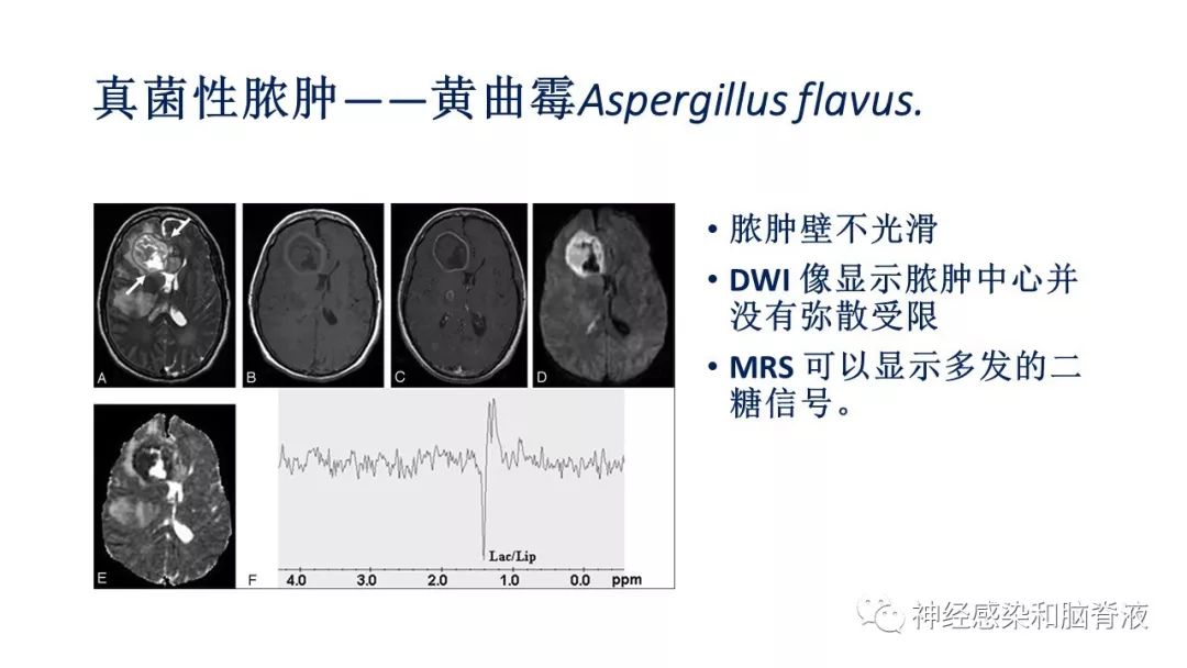 影像PPT - 【PPT】颅内环形强化：从原理到现象-49