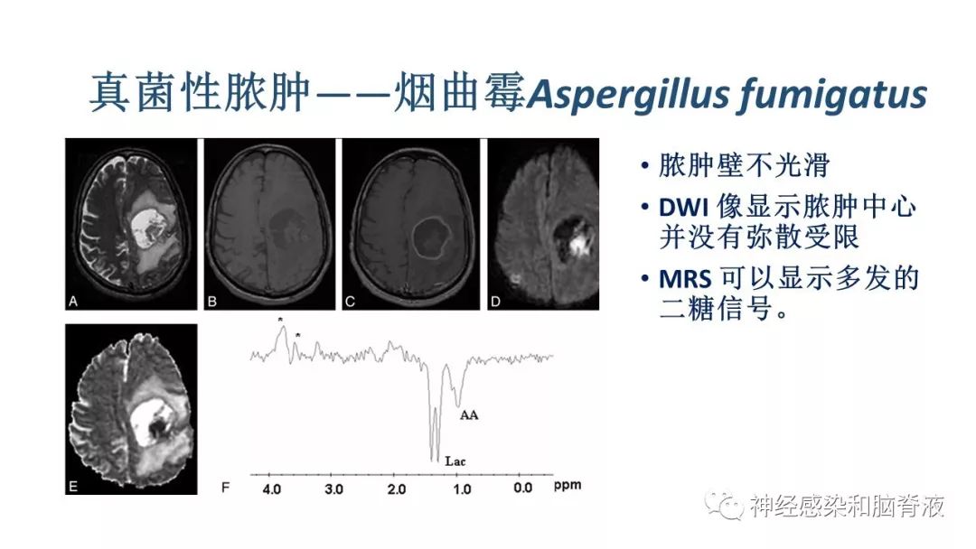 影像PPT - 【PPT】颅内环形强化：从原理到现象-50