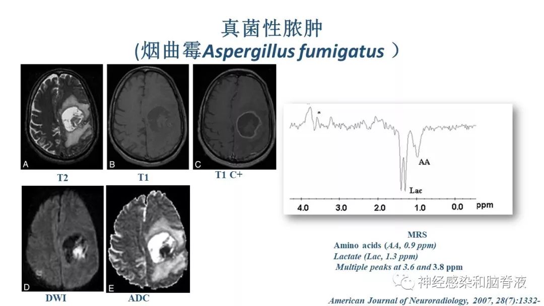 影像PPT - 【PPT】颅内环形强化：从原理到现象-51
