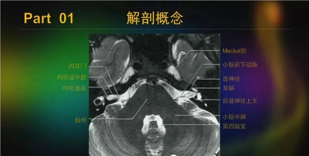 影像PPT - 【PPT】桥小脑角区占位性病变的MR诊断思路探讨-9