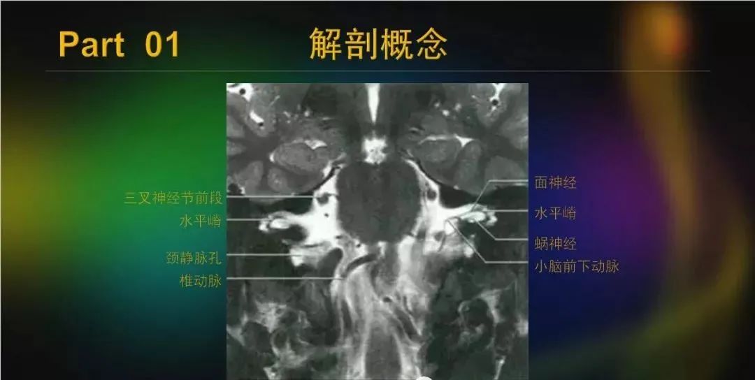 影像PPT - 【PPT】桥小脑角区占位性病变的MR诊断思路探讨-10