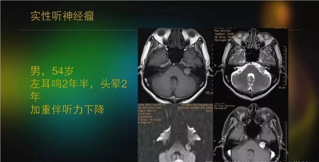 影像PPT - 【PPT】桥小脑角区占位性病变的MR诊断思路探讨-12