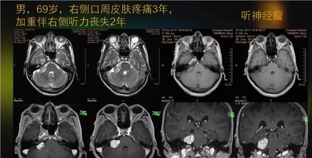 影像PPT - 【PPT】桥小脑角区占位性病变的MR诊断思路探讨-13