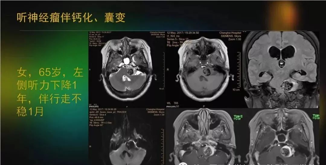 影像PPT - 【PPT】桥小脑角区占位性病变的MR诊断思路探讨-14