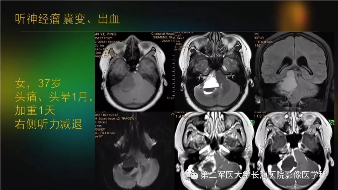 影像PPT - 【PPT】桥小脑角区占位性病变的MR诊断思路探讨-15