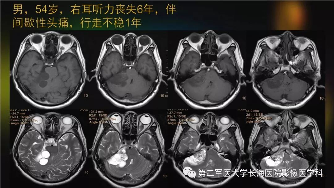 影像PPT - 【PPT】桥小脑角区占位性病变的MR诊断思路探讨-16