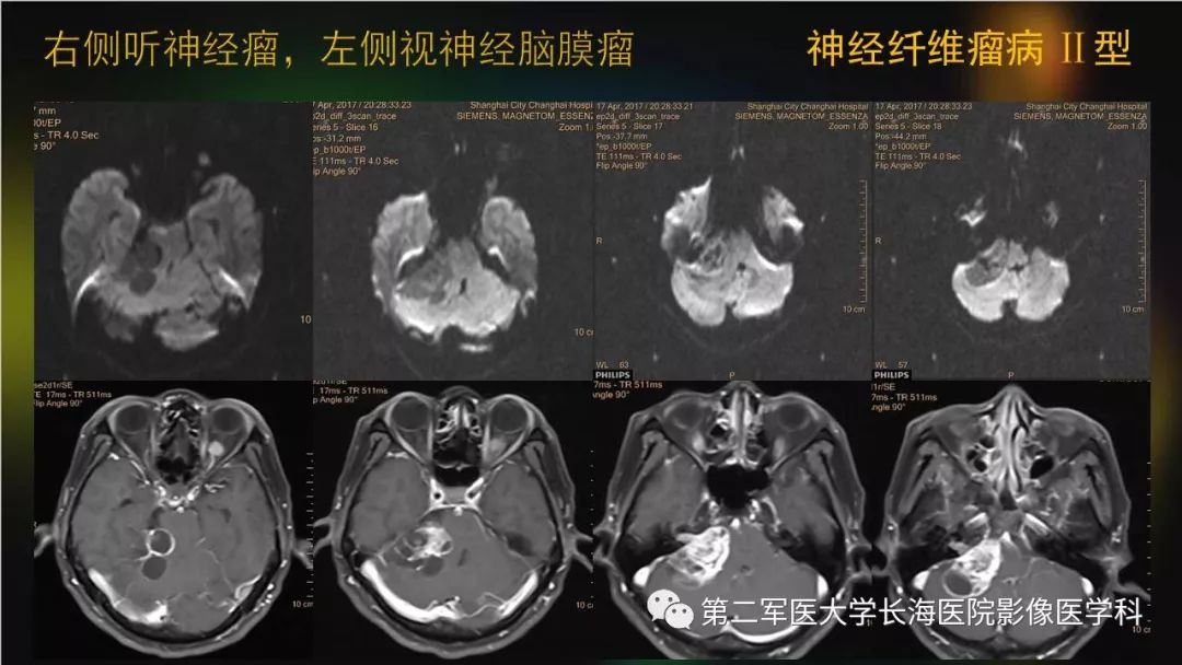 影像PPT - 【PPT】桥小脑角区占位性病变的MR诊断思路探讨-17