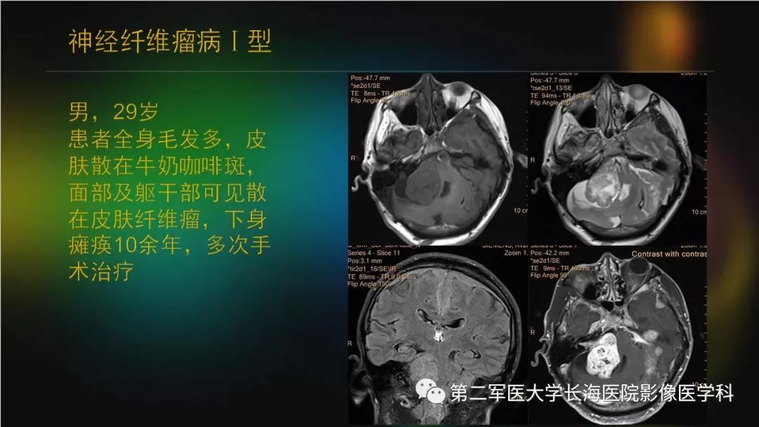 影像PPT - 【PPT】桥小脑角区占位性病变的MR诊断思路探讨-18