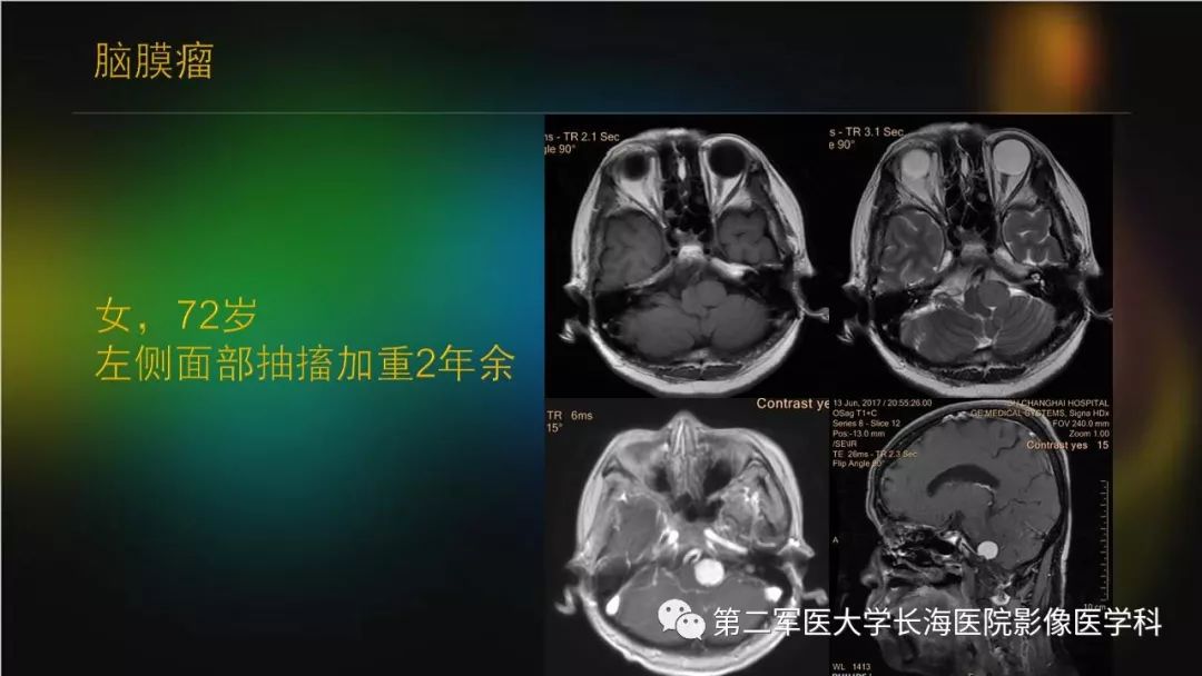 影像PPT - 【PPT】桥小脑角区占位性病变的MR诊断思路探讨-19