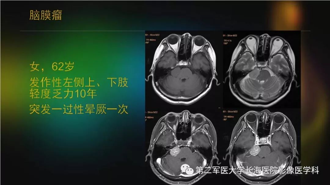 影像PPT - 【PPT】桥小脑角区占位性病变的MR诊断思路探讨-20