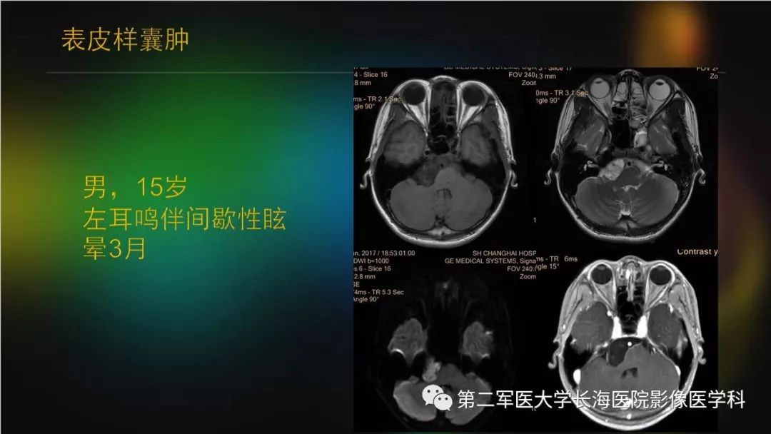影像PPT - 【PPT】桥小脑角区占位性病变的MR诊断思路探讨-21