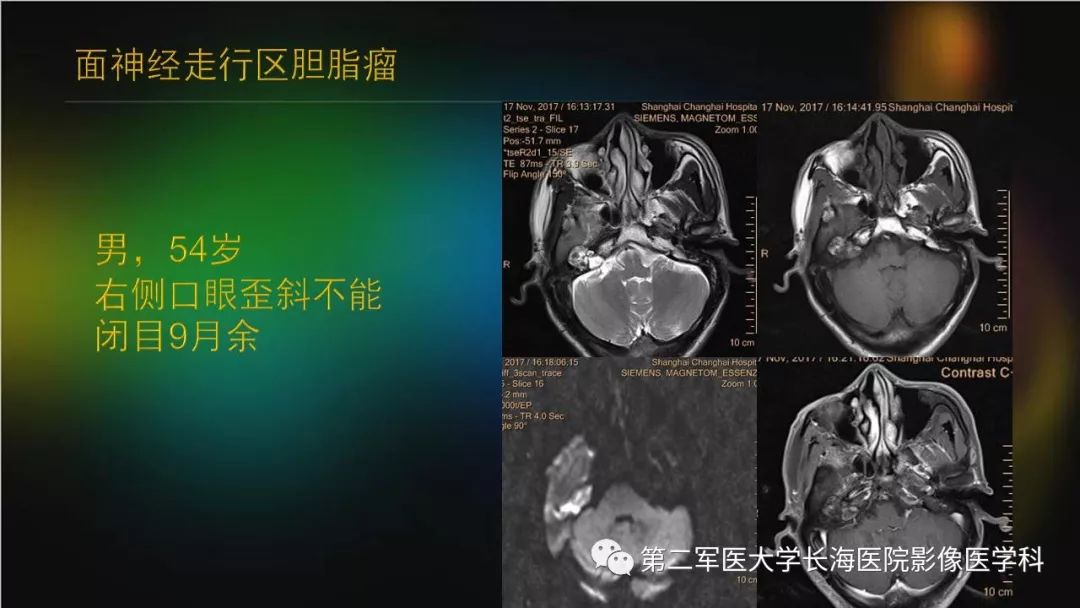 影像PPT - 【PPT】桥小脑角区占位性病变的MR诊断思路探讨-22