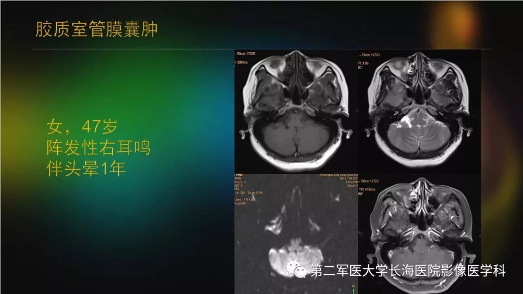 影像PPT - 【PPT】桥小脑角区占位性病变的MR诊断思路探讨-23