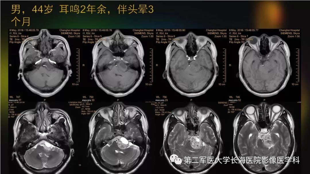 影像PPT - 【PPT】桥小脑角区占位性病变的MR诊断思路探讨-24