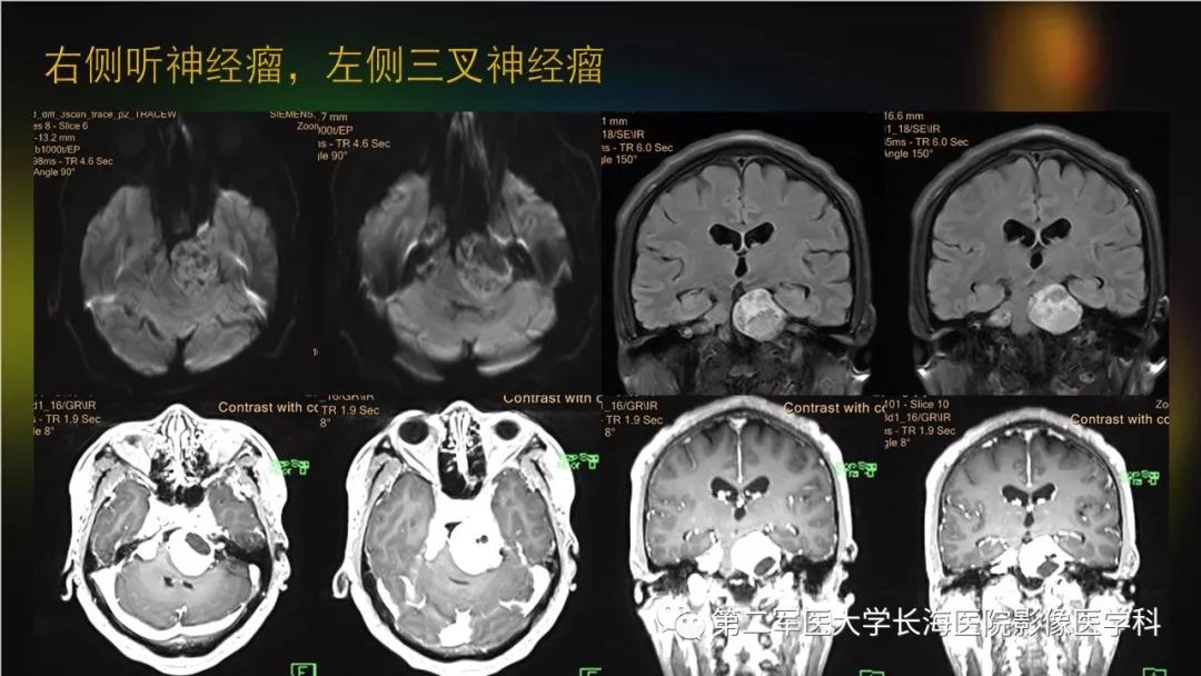 影像PPT - 【PPT】桥小脑角区占位性病变的MR诊断思路探讨-25