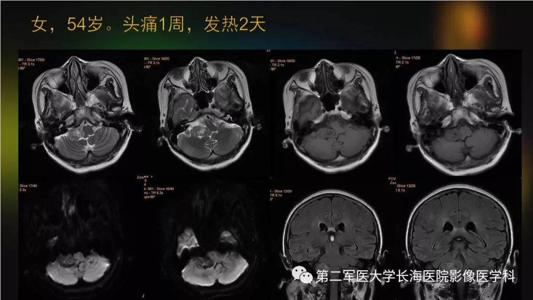 影像PPT - 【PPT】桥小脑角区占位性病变的MR诊断思路探讨-26