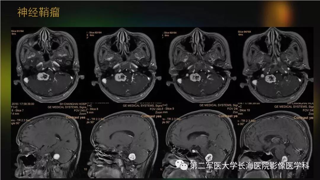影像PPT - 【PPT】桥小脑角区占位性病变的MR诊断思路探讨-27