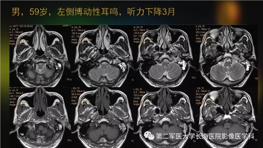 影像PPT - 【PPT】桥小脑角区占位性病变的MR诊断思路探讨-28