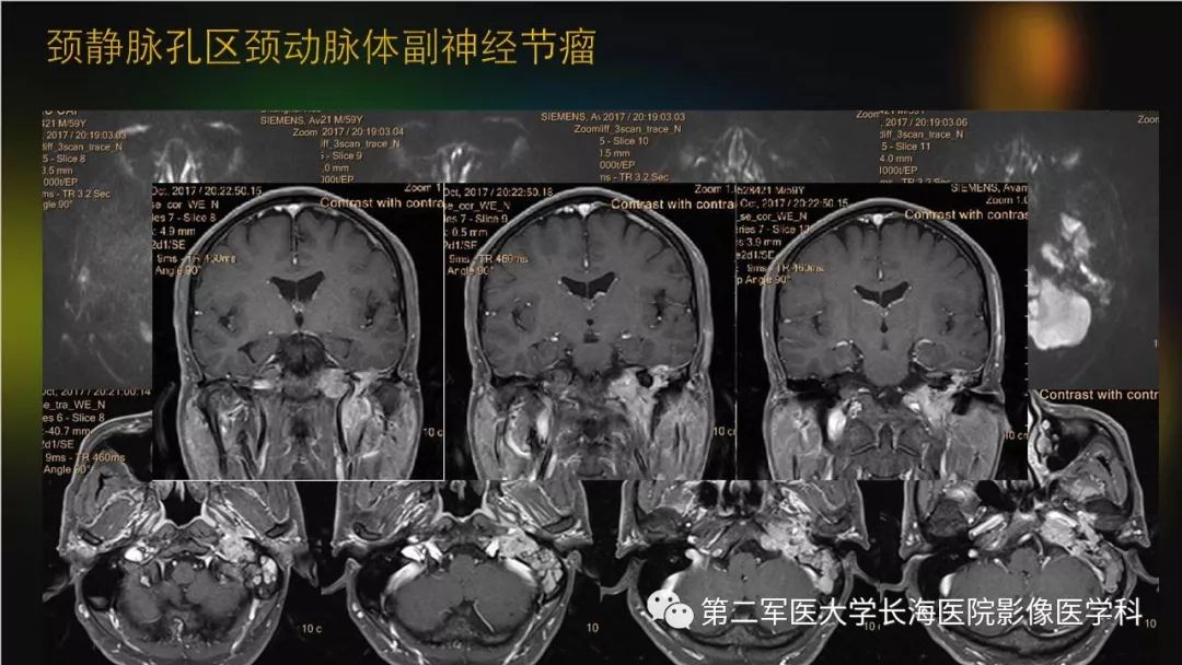 影像PPT - 【PPT】桥小脑角区占位性病变的MR诊断思路探讨-29