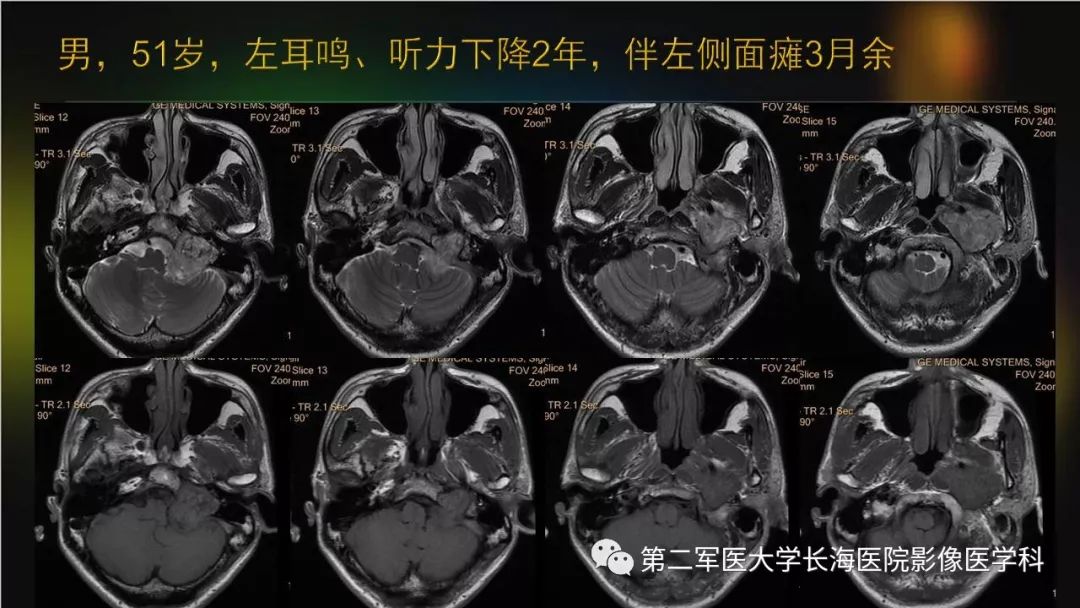 影像PPT - 【PPT】桥小脑角区占位性病变的MR诊断思路探讨-30