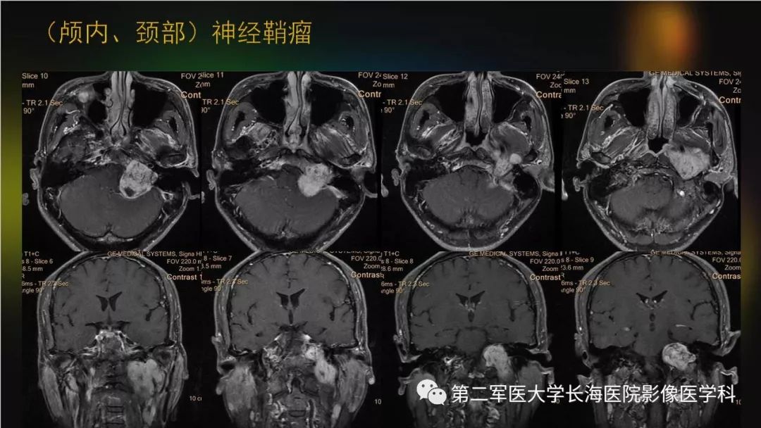 影像PPT - 【PPT】桥小脑角区占位性病变的MR诊断思路探讨-31