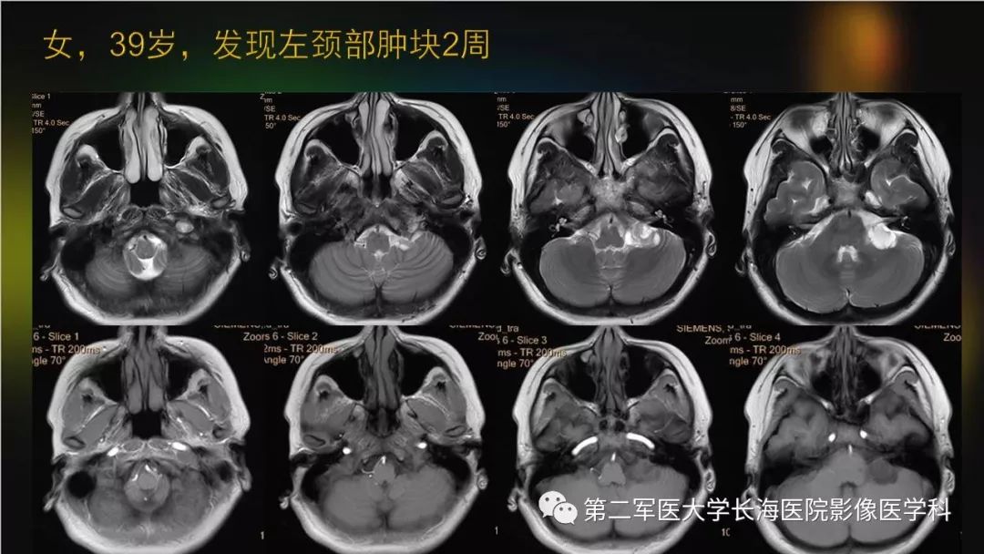 影像PPT - 【PPT】桥小脑角区占位性病变的MR诊断思路探讨-32