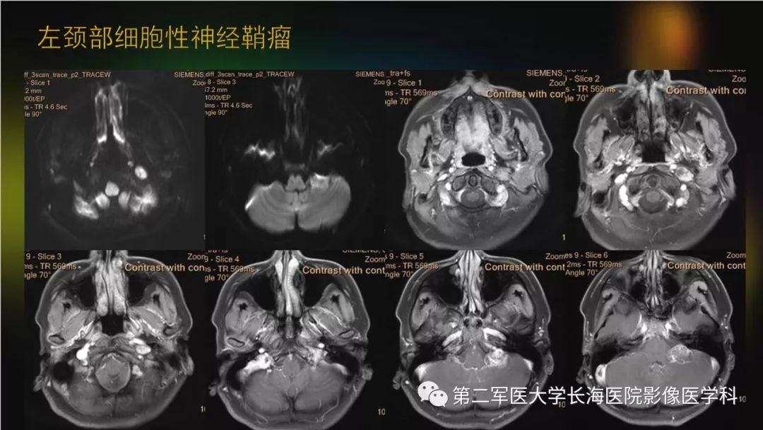 影像PPT - 【PPT】桥小脑角区占位性病变的MR诊断思路探讨-33