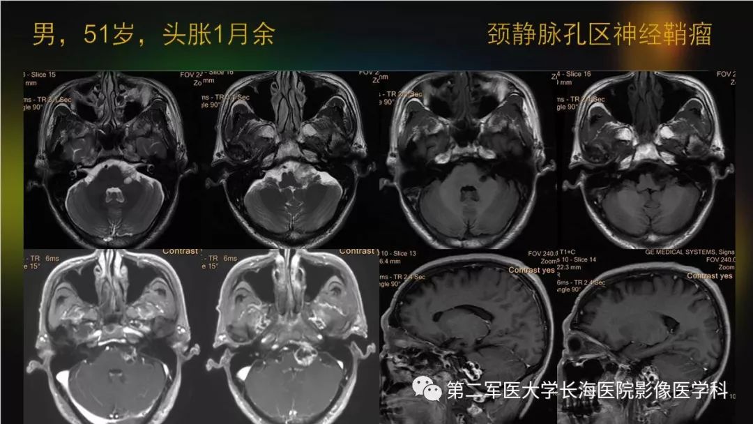 影像PPT - 【PPT】桥小脑角区占位性病变的MR诊断思路探讨-34