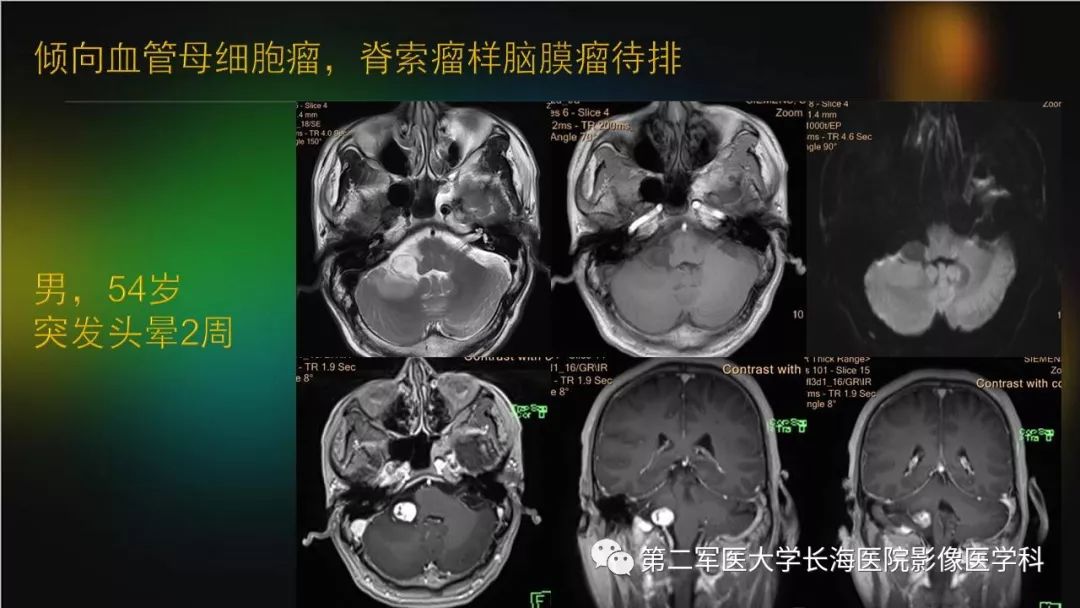 影像PPT - 【PPT】桥小脑角区占位性病变的MR诊断思路探讨-35