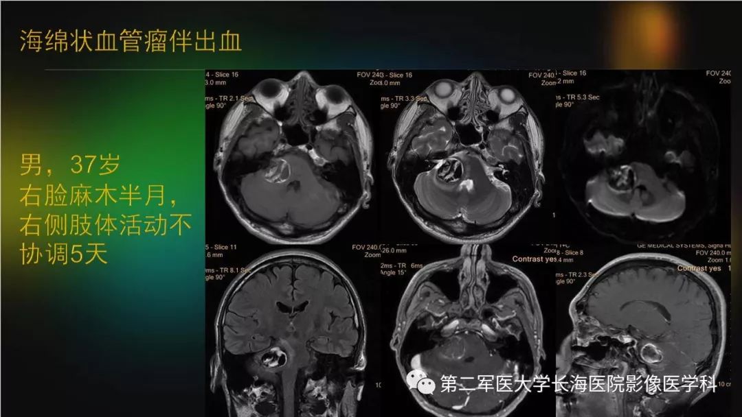 影像PPT - 【PPT】桥小脑角区占位性病变的MR诊断思路探讨-36