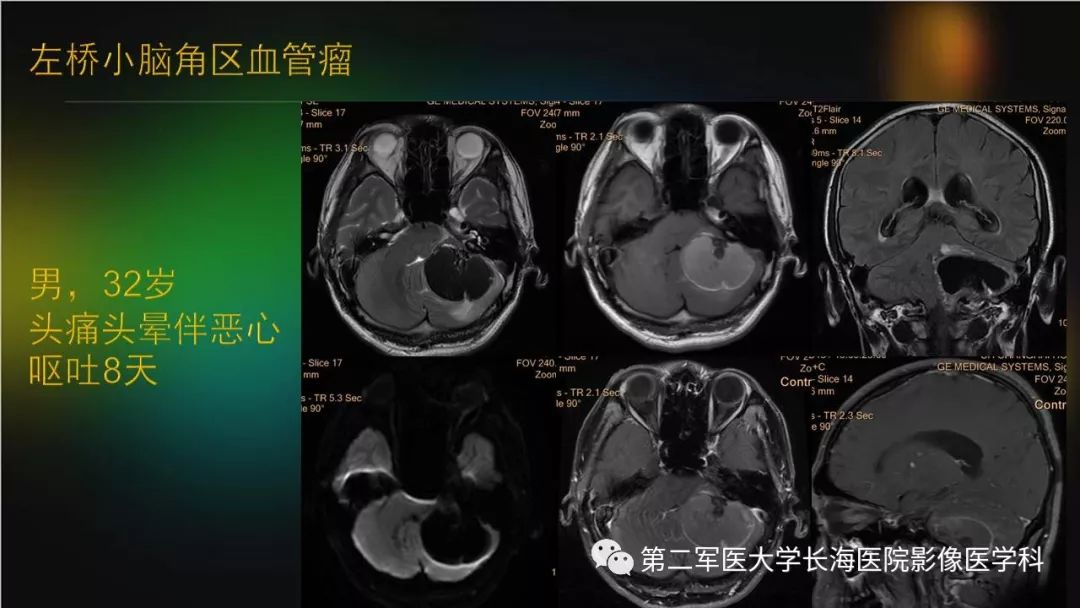影像PPT - 【PPT】桥小脑角区占位性病变的MR诊断思路探讨-37