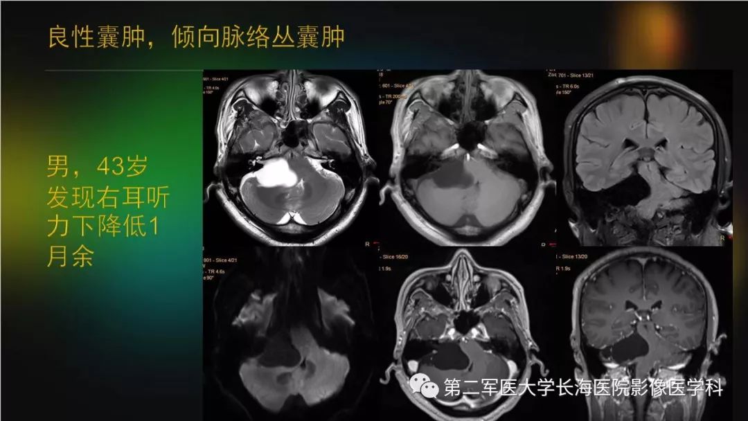影像PPT - 【PPT】桥小脑角区占位性病变的MR诊断思路探讨-38