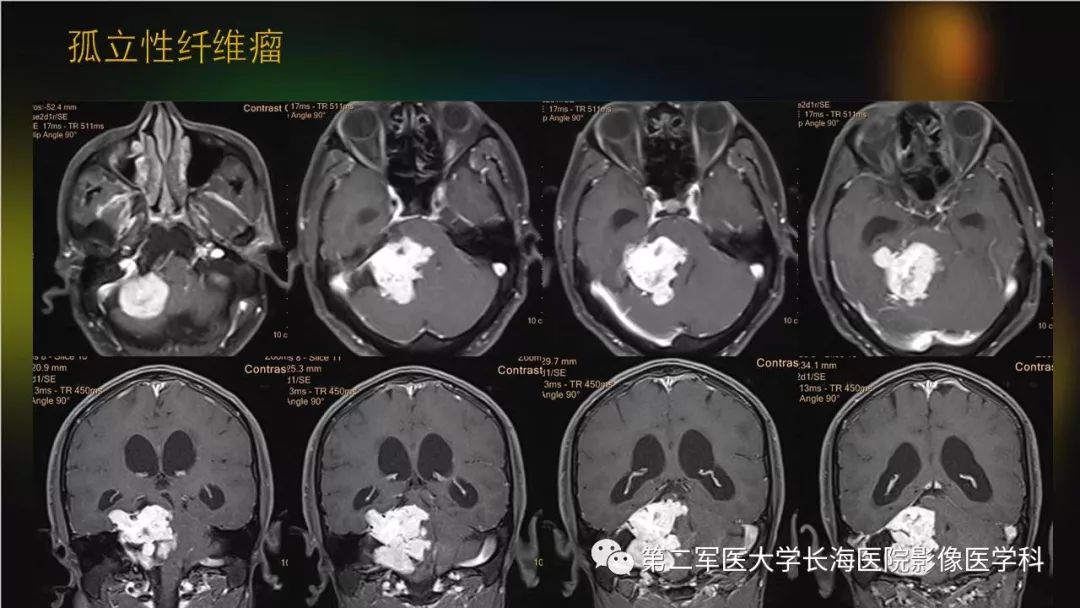 影像PPT - 【PPT】桥小脑角区占位性病变的MR诊断思路探讨-39