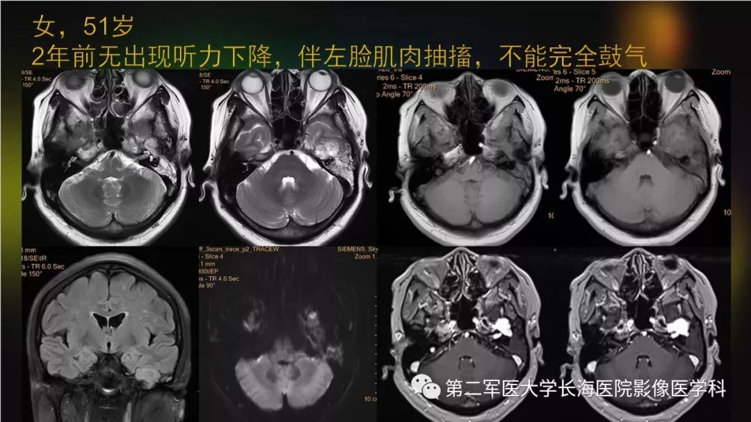 影像PPT - 【PPT】桥小脑角区占位性病变的MR诊断思路探讨-40
