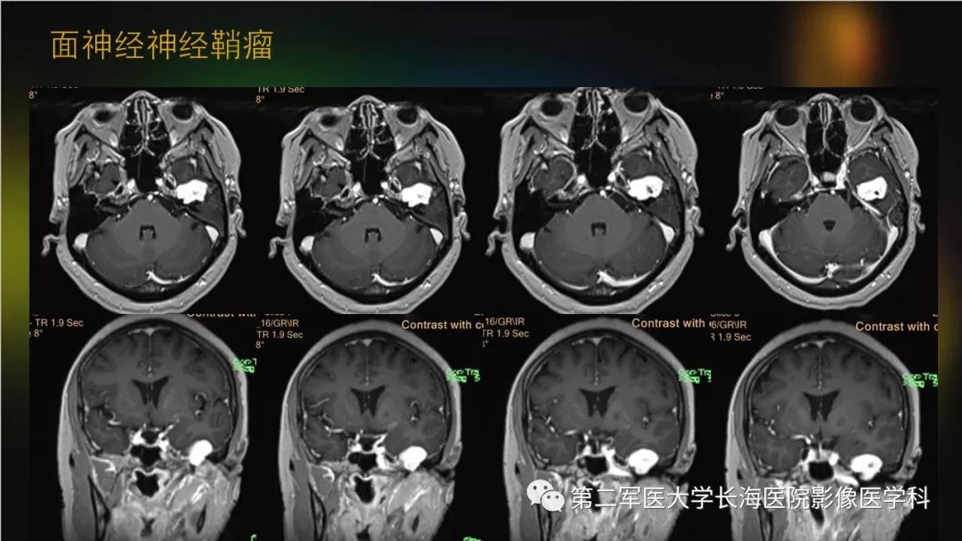 影像PPT - 【PPT】桥小脑角区占位性病变的MR诊断思路探讨-41
