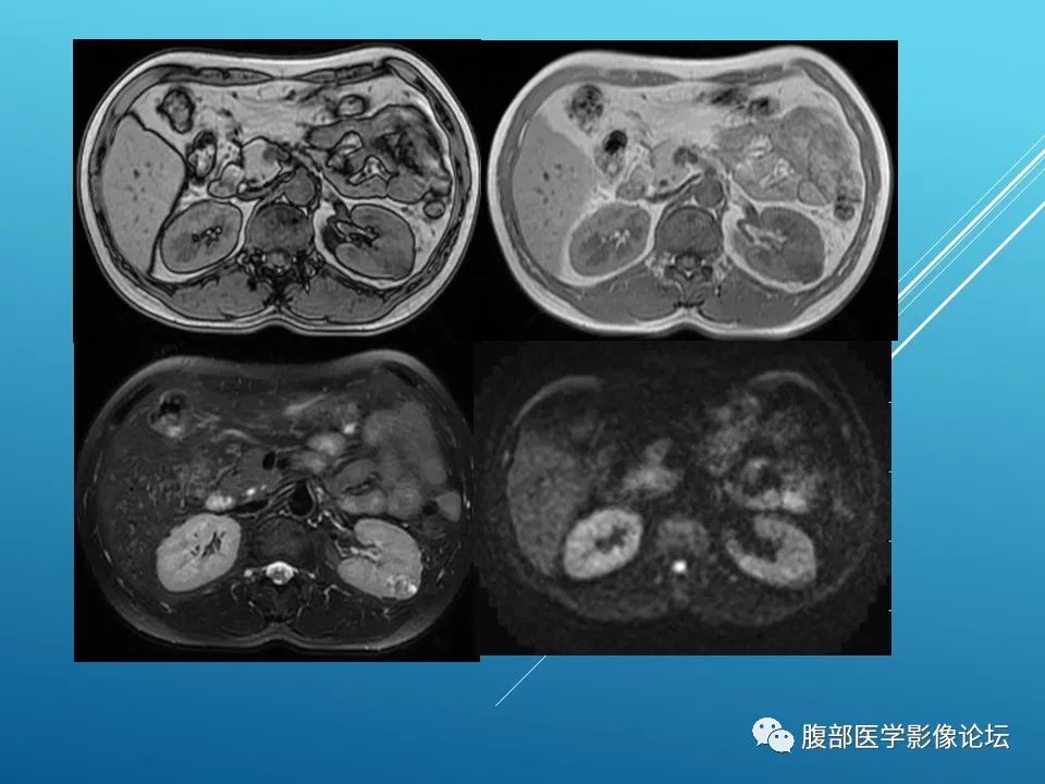 影像PPT - 【病例】肾脏透明细胞癌1例MR影像-3