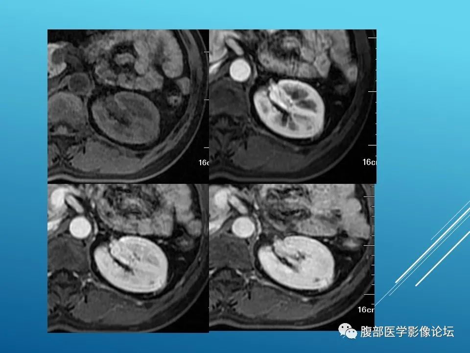 影像PPT - 【病例】肾脏透明细胞癌1例MR影像-4