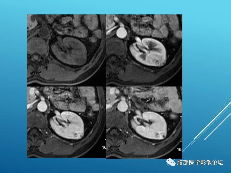 影像PPT - 【病例】肾脏透明细胞癌1例MR影像-5