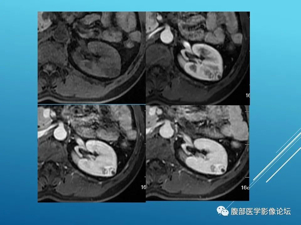 影像PPT - 【病例】肾脏透明细胞癌1例MR影像-6