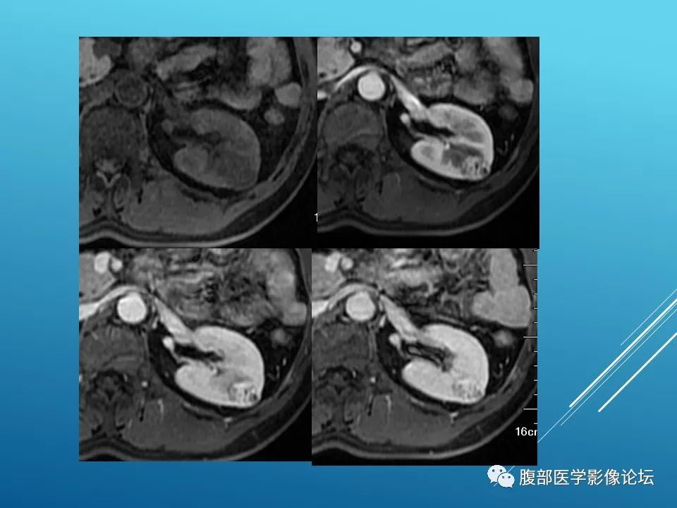 影像PPT - 【病例】肾脏透明细胞癌1例MR影像-7